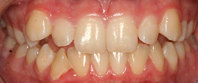 Teeth Before Teeth Before