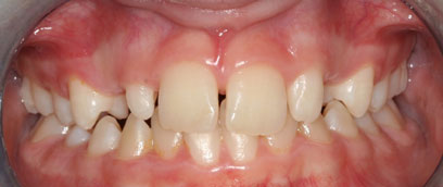 Teeth Before Teeth Before