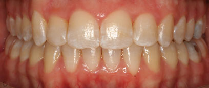 Teeth After Teeth After